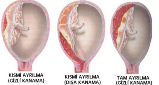  ablasyo plasenta, plasenta dekolmanı, abruptio plasenta, plasentanın erken ayrılması