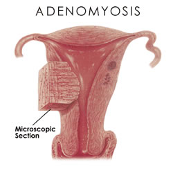  adenomyosis, adenomyom