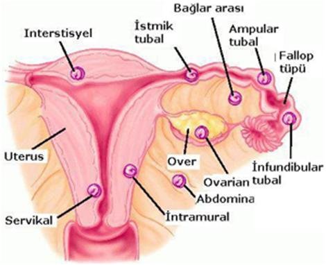  Dış gebelik yerleşim yerleri