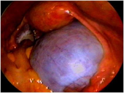  Endometrioma çikolata kisti