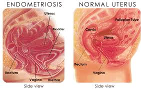  endometriozis
