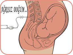  Ağrısız doğum, epidural anestezi