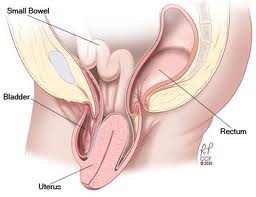  genital-organlarda-sarkma-ve-gevseme, rahim mesane barsak sarkması