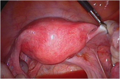  hafif endometriozis