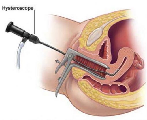  Histeroskopi