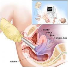  jinekolojik-vajinal ultrason-