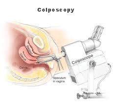  kolposkopi