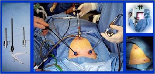  laparoskopi işlemi