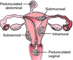  myom, leiomyom, fibroid