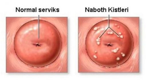  nabothi ve normal serviks