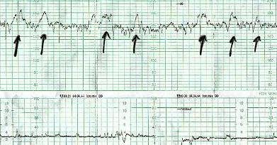  nonstress test NST