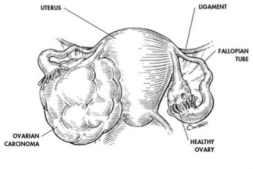  over - yumurtalık kanseri