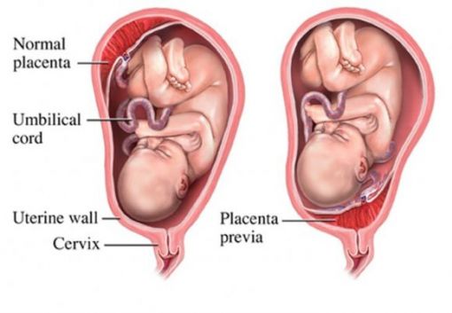  plasenta previa