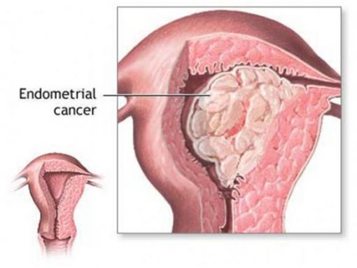  rahim kanseri