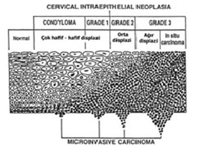 servikal intraepitelyal neoplazi - CIN - rahim ağzı kanseri öncü lezyonlar