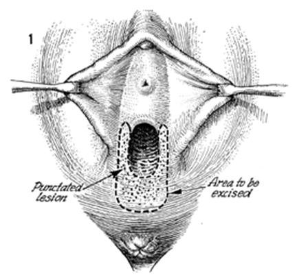  Vulvar vestibulit, vestibular adenit, vulvodini, ağrılı cinsel ilişki, disparoni